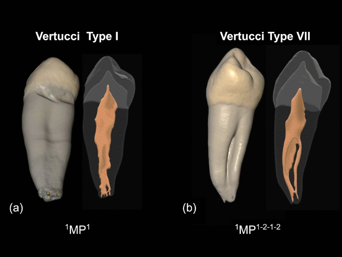 Ricostruzioni micro-CT di due premolari inferiori: una mostra un percorso canalare semplice, l’altra una ramificazione complessa