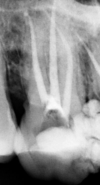 Primo dettaglio di una radiografia endorale con percorsi canalari trattati in un molare