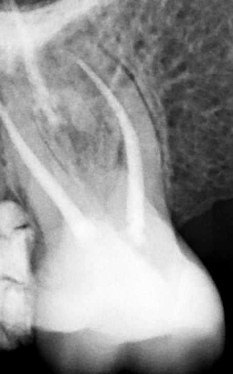 Secondo dettaglio radiografico dell’anatomia di un molare