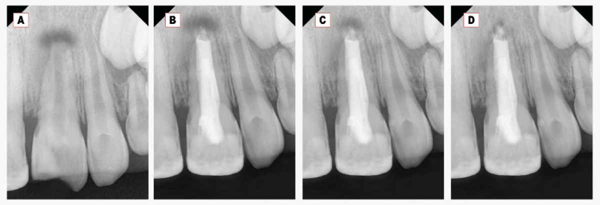 Quattro radiografie di un incisivo permanente immaturo: prima del trattamento, subito dopo MTA plug e otturazione, e ai controlli