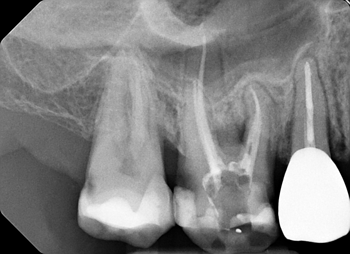 Radiografia postoperatoria del dente 16