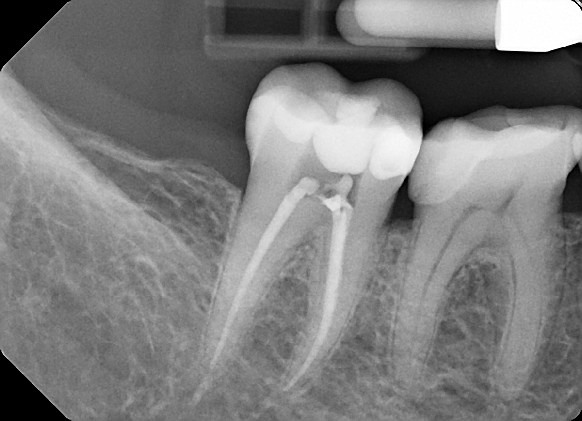 Radiografia postoperatoria del dente 47