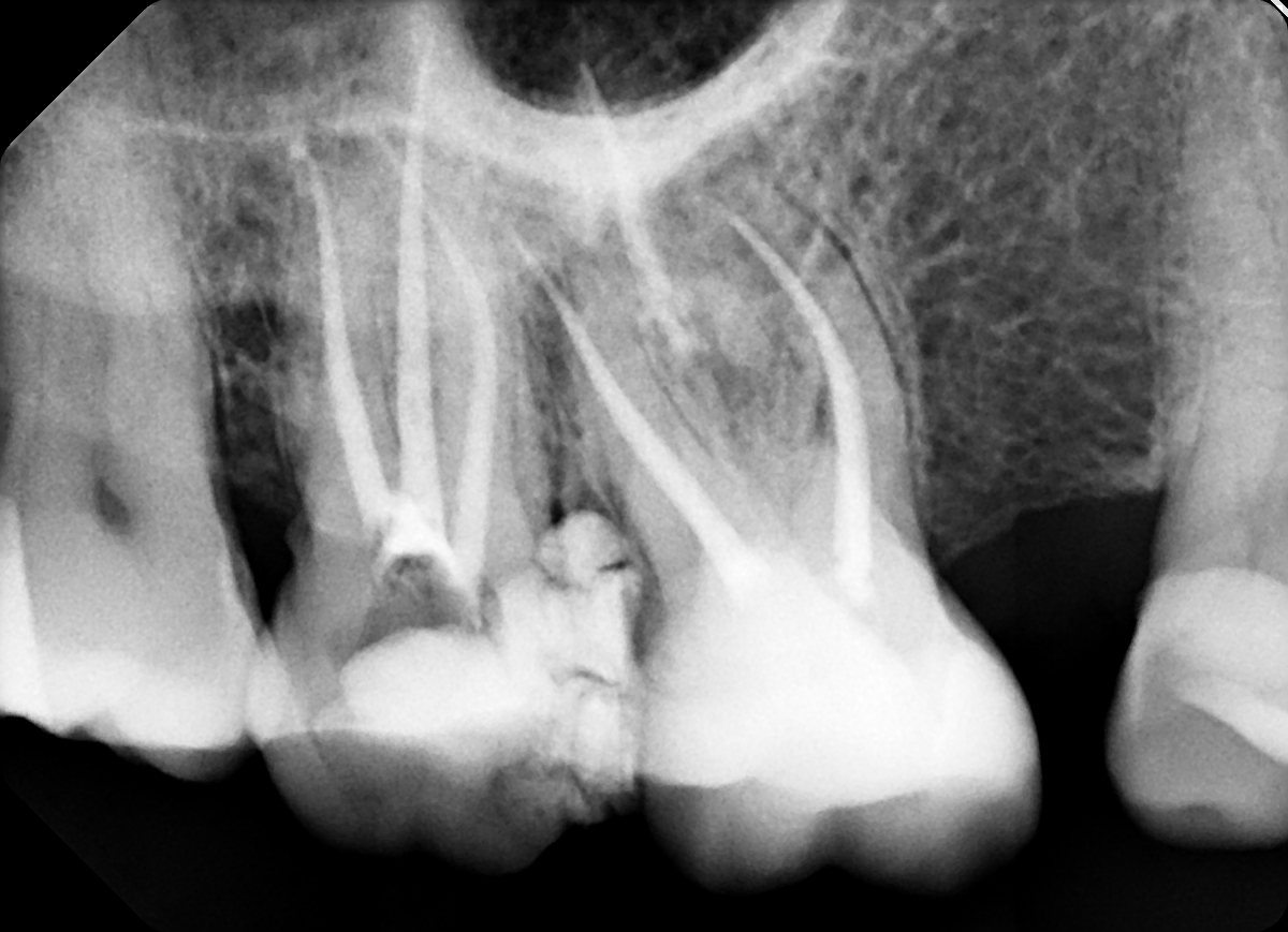 Radiografia postoperatoria del dente 17