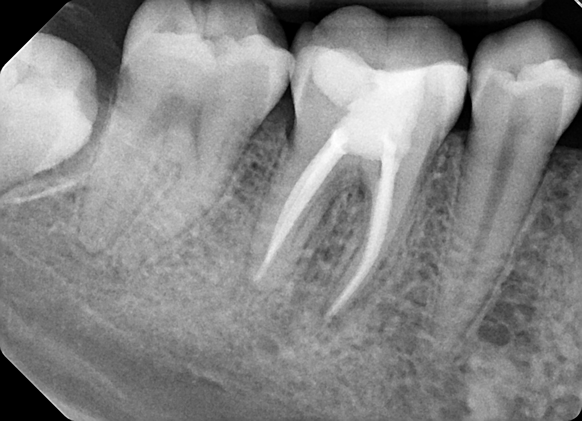 Radiografia postoperatoria del dente 46