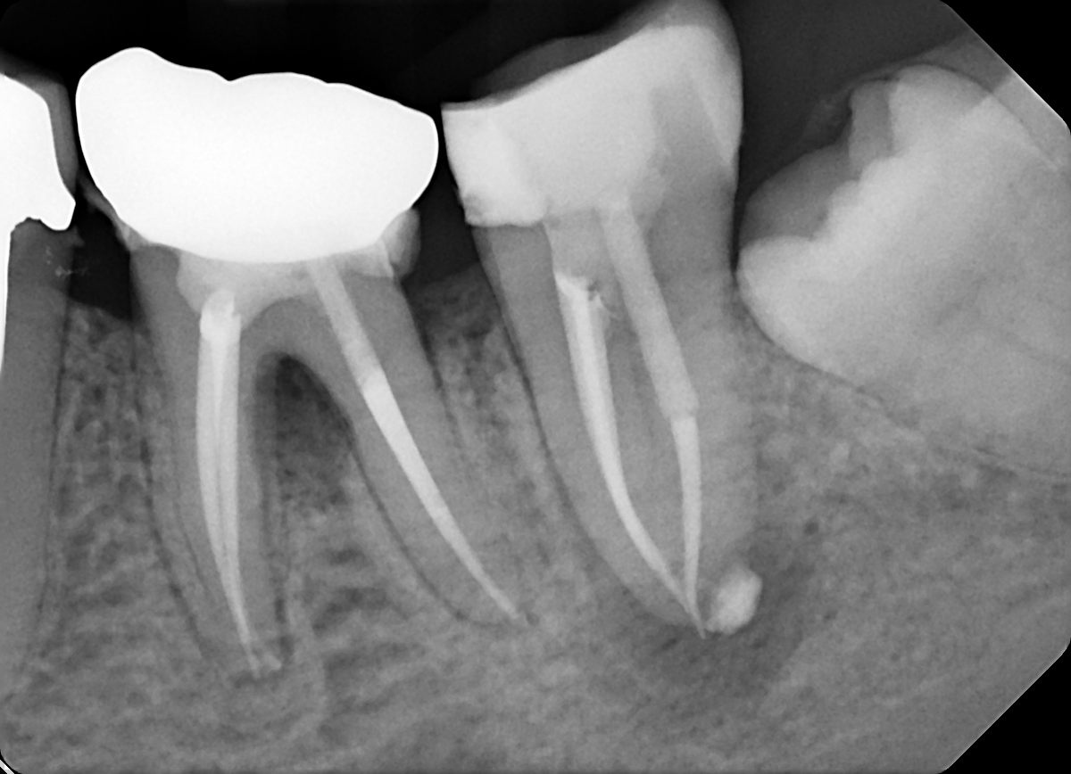 Radiografia del dente 37 dopo trattamento endodontico