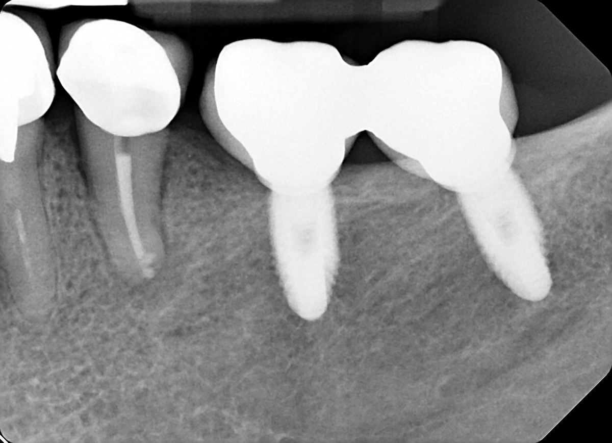 Radiografia postoperatoria del ritrattamento del dente 35
