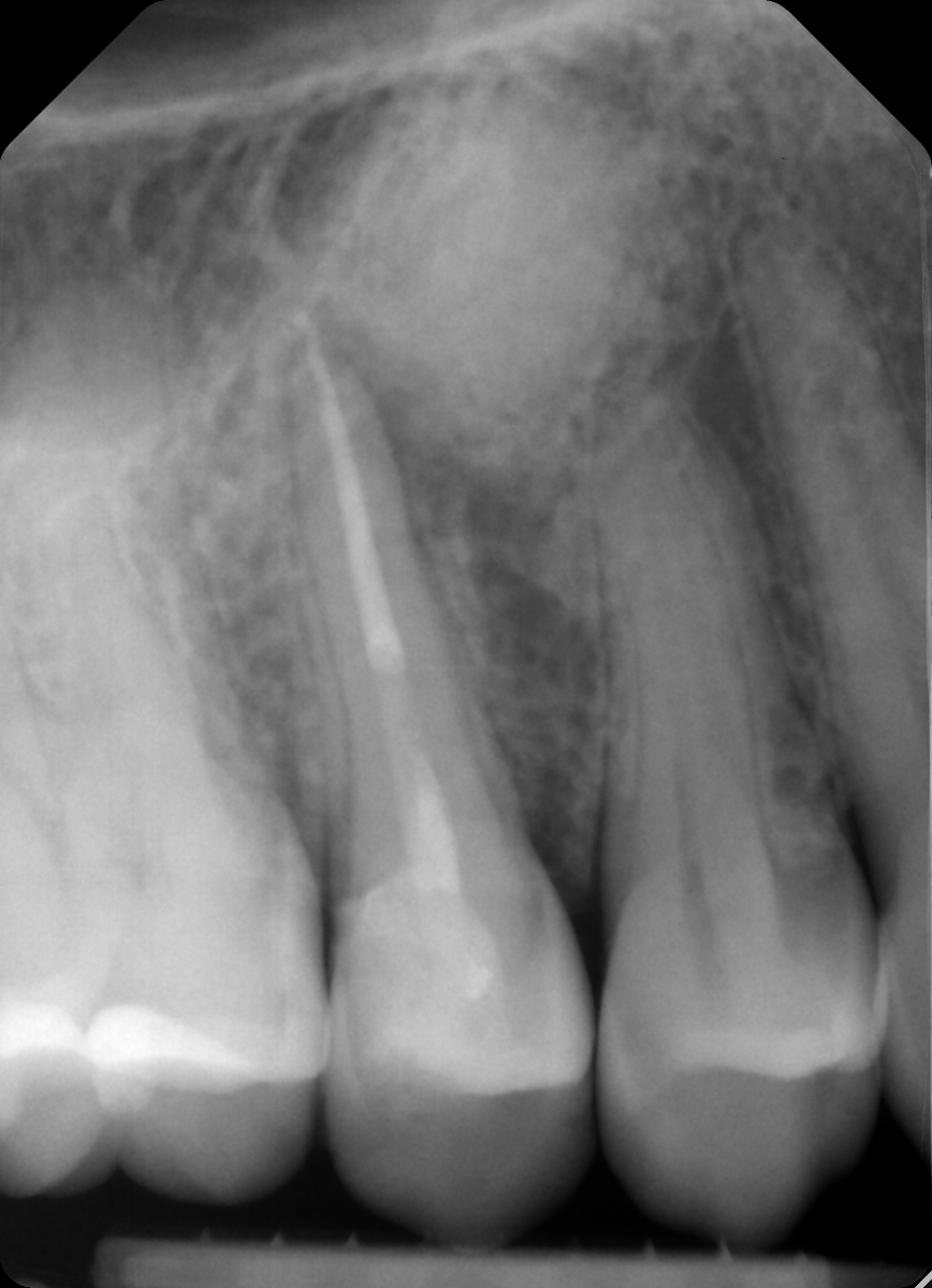 Radiografia postoperatoria del dente 15