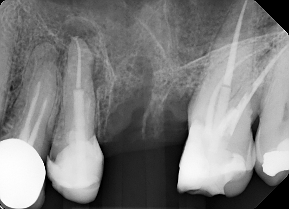 Radiografia conclusiva dei denti 25 e 27