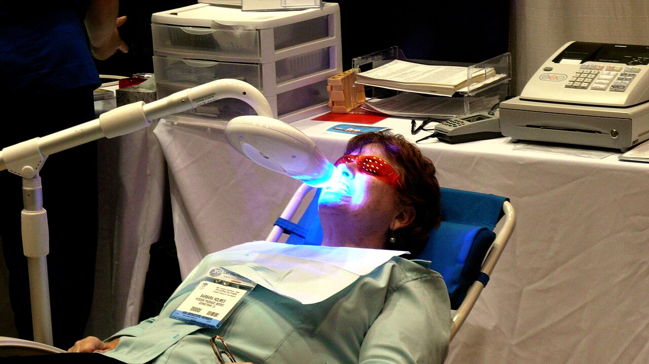 Esempio illustrativo di trattamento sbiancante esterno in studio
