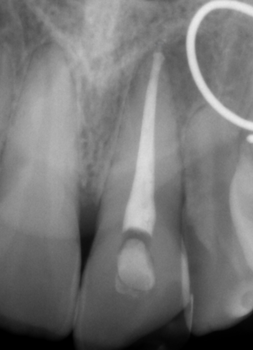 Radiografia postoperatoria dopo la terapia canalare