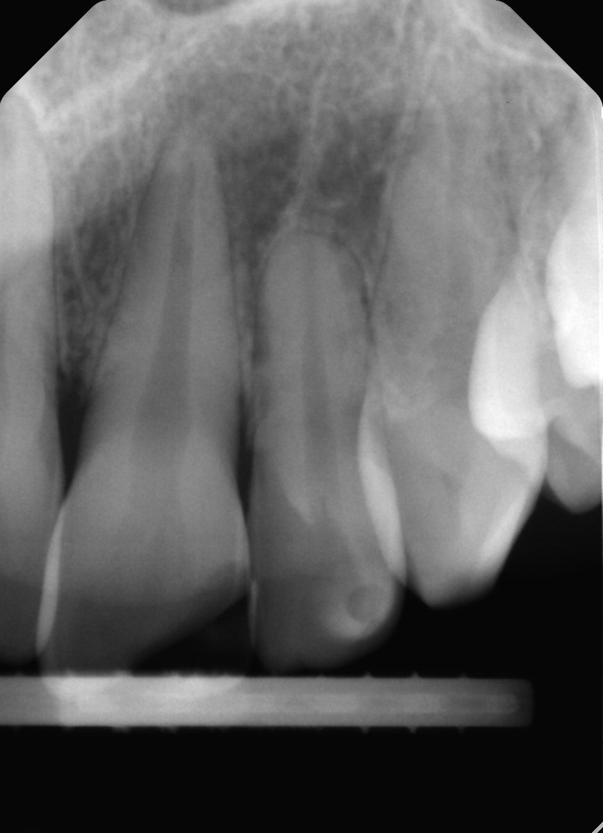 Radiografia preoperatoria del caso, prima della terapia canalare